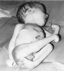 deformities in an infant whose mother had varicella at 12 weeks' gestation.