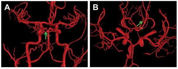 3. ΥΠΟΛΟΓΙΣΤΙΚΗ ΜΑΓΝΗΤΙΚΗ ΑΓΓΕΙΟΓΡΑΦΙΑ (QUANTITATIVE MAGNETIC RESONANCE ANGIOGRAPHY - QMRA) Η μαγνητική αγγειογραφία έχει εφαρμοστεί στη μελέτη πέραν των ποιοτικών και των ποσοτικών της αιματικής