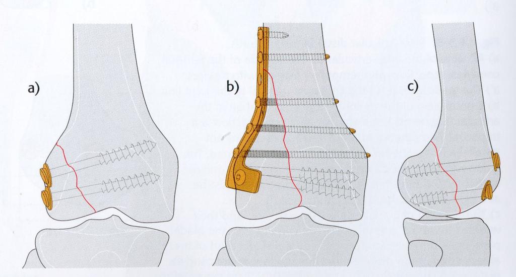 Χειρουργική θεραπεία Οστεοσύνθεση με πλάκα