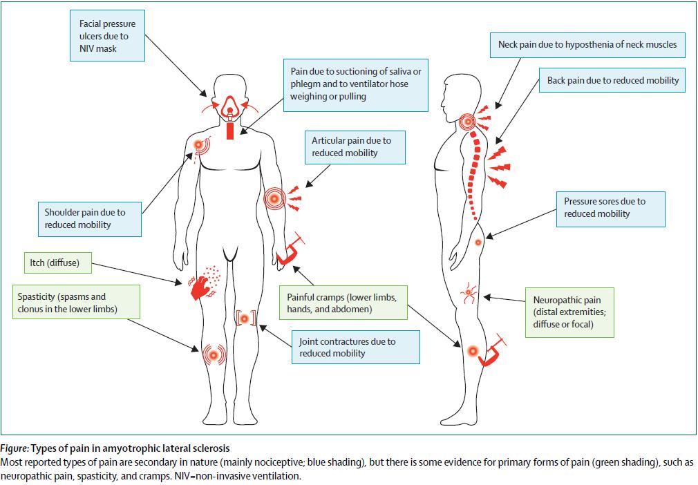 την ευαισθησία στον πόνο καθώς μειώνει το κατώφλι του πόνου στους ασθενείς αυτούς. Εικόνα 4.1: Τύποι πόνου στην Πλάγια Αμυοτροφική Σκλήρυνση. Πηγή: Chio et al.