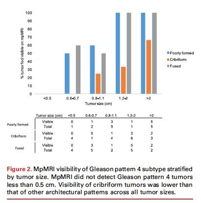 Limitations of MRI Gleason 4 pattern is heterogenous-glandular architecture within Gleason pattern 4 is important o Poorly formed glands o Cribriform (up to 40%) o Glomeruloid o Fused glands