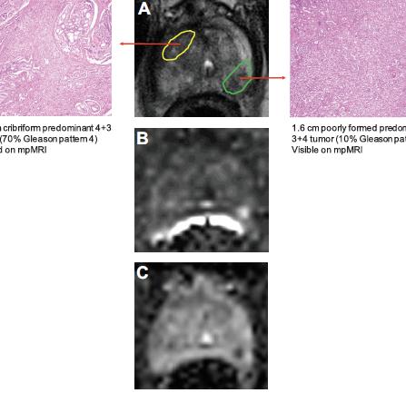 Α= T2-weighted image B= high b value DWI C= ADC map 27.