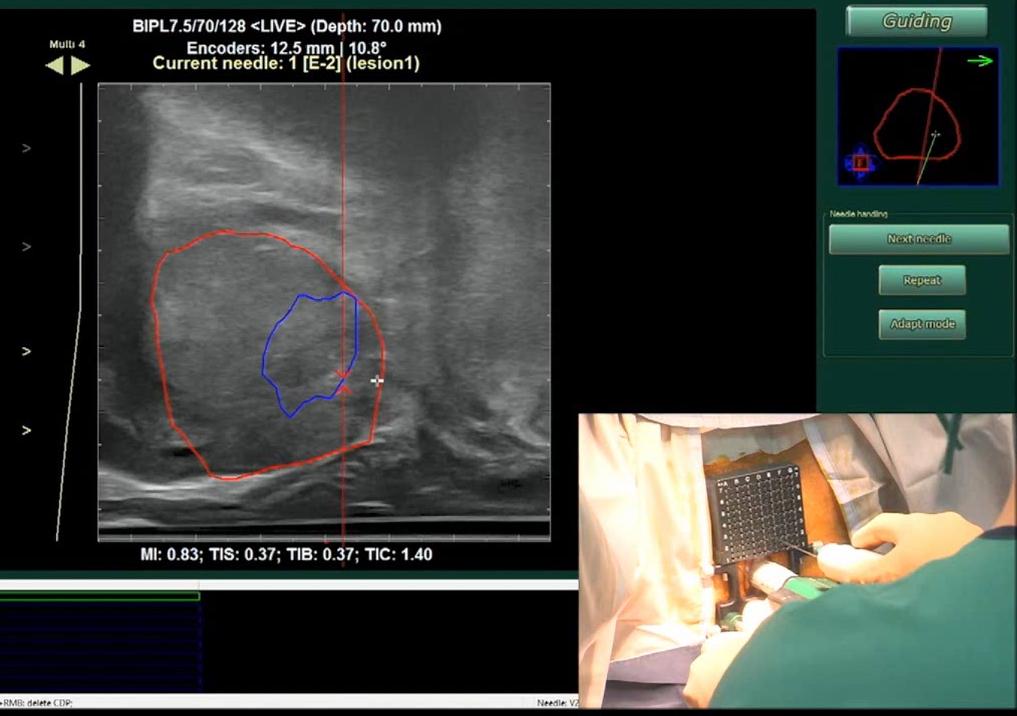 Navigated & targeted biopsies 61 MRI-targeted Bx only?