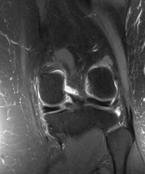 АРХИВИ НА ЈАВНОТО ЗДРАВЈЕ posterior root vertical tear at the MM and the groups with horizontal tears, were correlated with the control group with medial compartment cartilage degeneration with or