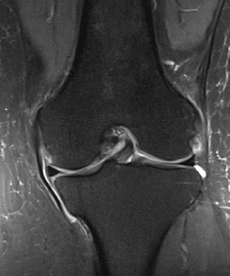 Results In the first group that included 18 patients with a posterior root vertical tear of the MM, 50% were males, with a mean age of 57 years (range 22 to 78 years).