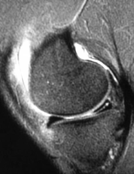 Vol.5 No.2 2013 Table 2. Frequency of extrusion of medial meniscus in all groups derate in 76.7% of the cases. The rest of the cases in this group had severe form of fibrovascular tissue (16.7%).