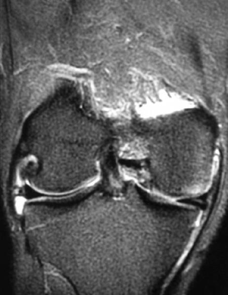 Fifty percentage of the cases had extrusion 3mm (Table2). Medial compartment cartilage was normal in the majority of the cases (76.6%), and all other had minor changes of the cartilage.