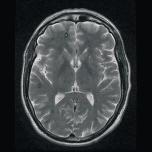 Εικόνα 4: Τυπική εικόνα εγκεφαλική σηραγγώδους δυσπλασίας.