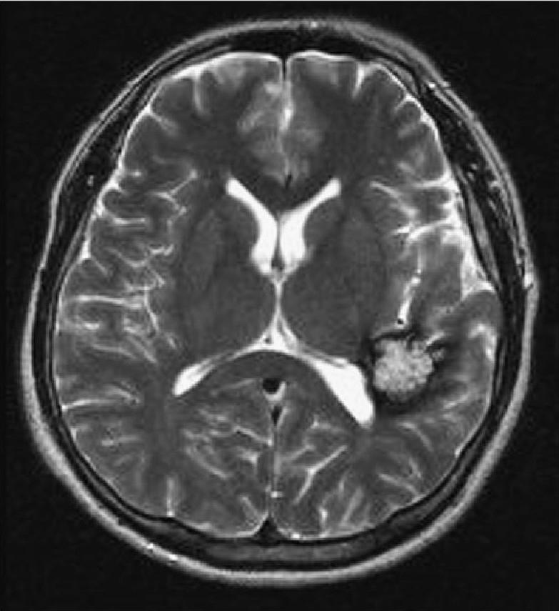 (β) T2W MRI ακολουθία αποκαλύπτει ένα δικτυωτό σχηματισμό υψηλής έντασης σήματος που περιβάλλεται από μια χαμιηλής έντασης (α) σήματος παρυφή, τυπική εικόνα των (β) σηραγγωδών δυσπλασιών δίκην ''pop