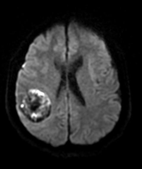 σημαντικά την εμφάνιση της σηραγγώδους δυσπλασίας στην MRI, όπως αναφέρουν οι Zabramski et al.