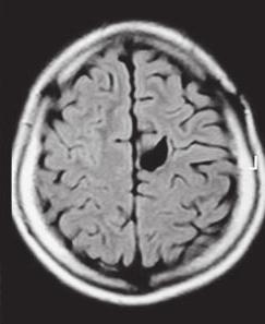 διεγχειρητική MRI (imri).124-127 Σε ασθενείς με παρουσία επιληπτικών κρίσεων προτείνεται το προεγχειρητικό ηλεκτροεγκεφαλογράφημα αλλά και το διεγχειρητικό ηλεκτροφλοιογράφημα.