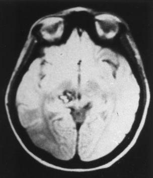 Εικόνα 11: (α) MRI που αποκαλύπτει εστία συμβατή με σηραγγώδη δυσπλασία στο δεξιό θάλαμο. (β) MRI του ίδιου ασθενούς, 8 χρόνια μετά, αναδεικνύει τη μεγέθυνση της βλάβης.128 (α) (β) Γ.4.