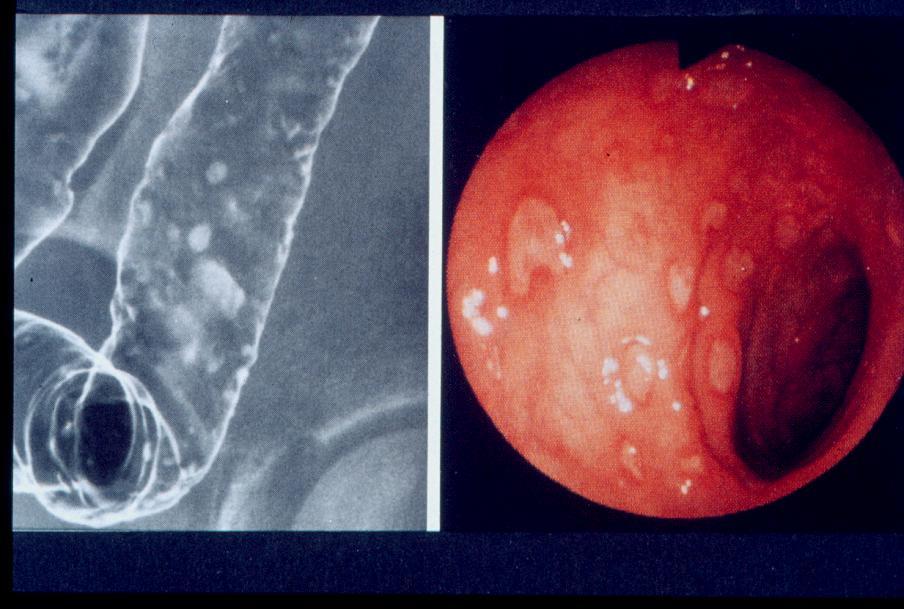 Ν. Crohn