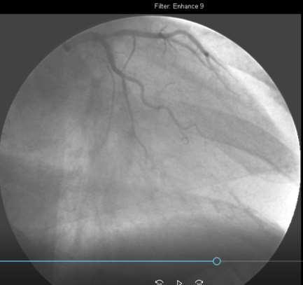 Case 4 47y extremely obese Δυσπνοικά επεισόδια και άλγος επιγαστρίου,