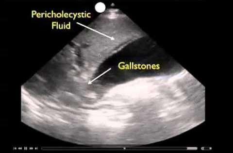 Case 4 47y extremely obese Δυσπνοικά επεισόδια με άλγος επιγαστρίου, δυσφορία, μετεωρισμός June 2017 PCI :LAD on DAPT (Ticagrelor /ASA) Αυγουστος 2017 πολλαπλά ήπια