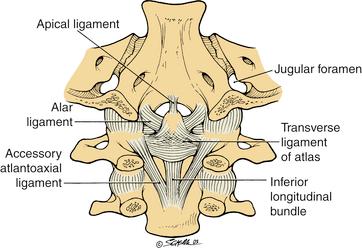 CROWNED DENS SYNDROME Ονομασία από Bouvet et al το 1985 1 Εναπόθεση κρυστάλλων CPP (ή ΗΑ) στην ΑΜΣΣ Η εναπόθεση πέριξ του οδόντα είναι δίκην κορώνας (ή άλω)