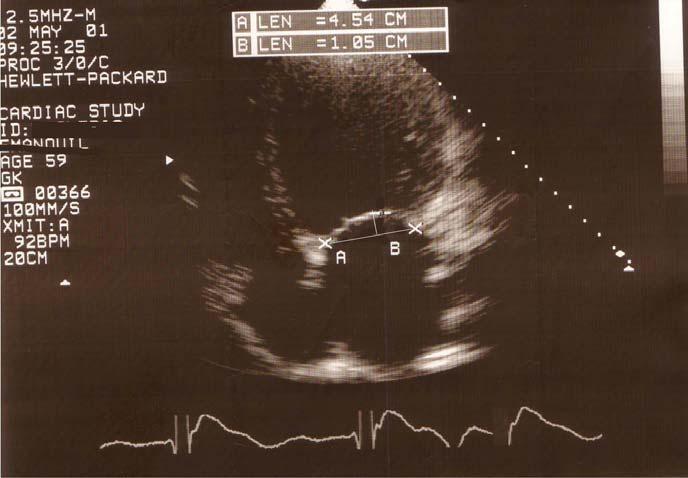 Functional MR An apical displaced coaptation point with failure of the mitral leaflets to