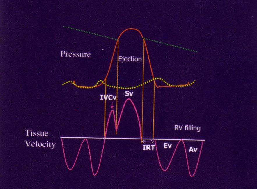 Εκτίμηση πίεσης ΔΕΞΙΟΥ ΚΟΛΠΟΥ Η ταχύτητα (TDI) του βασικού τμήματος του ελεύθερου τοιχώματος της δεξιάς κοιλίας (φάση ισοογκωτικής συστολής) σχετίζεται με την μέση πίεση