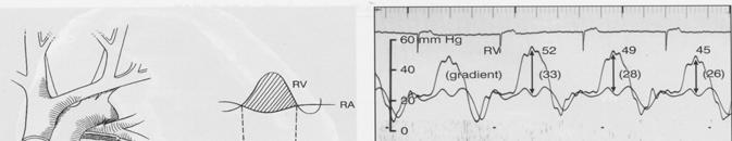 βαλβίδας) RVSP = 4 x V (TR) 2 + RA PR-ED Υπολογισμός