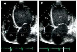 Echocardiographic abnormalities in cardiomyopathy LV dilatation Increasing sphericity (L=D) Apical/Lateral displacement of papillary muscles functional MR LV thrombus Normal/reduced wall