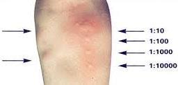Δερματικές δοκιμασίες Skin prick test (SPT) Intradermal skin test Patch test Δοκιμασίες νυγμού (skin prick tests): με αραιώσεις εκχυλίσματος αλλεργιογόνου