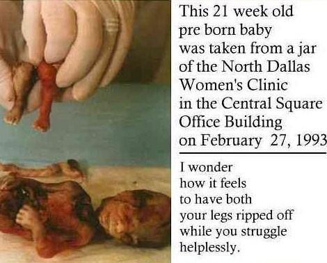 6. D & X: (20 η έως 32 η + εβδομάδα) Είναι γνωστή ως άμβλωση μερικής γέννησης, μια επικίνδυνη μέθοδο που χρησιμοποιείται στα τελευταία στάδια της άμβλωσης (Schulman 1994).
