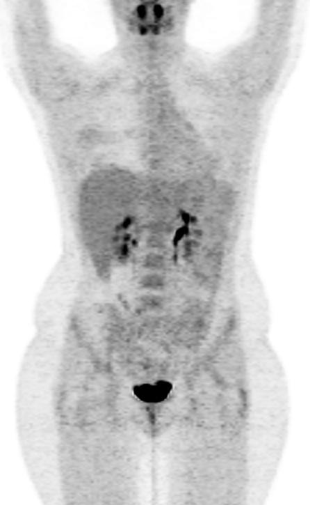 επαναληπτικού PET/CT Μετά από