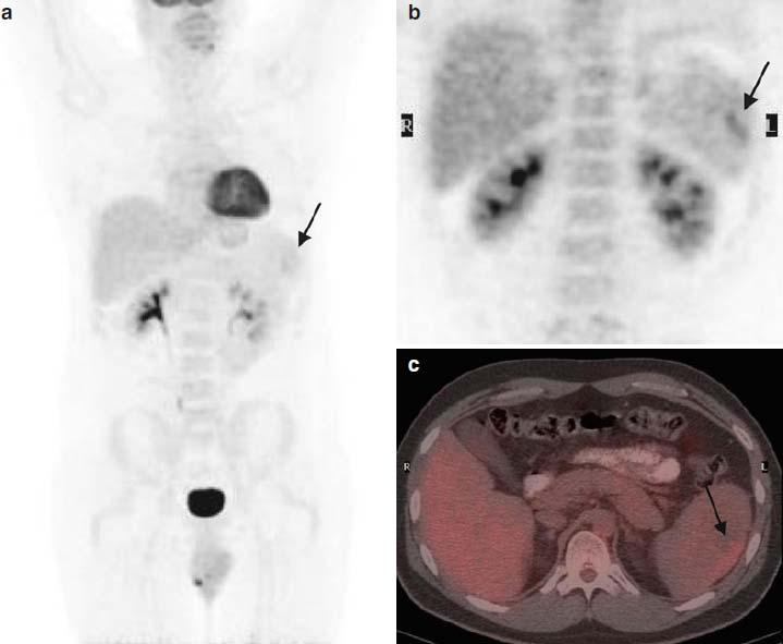 33 ετών DBLCL(IISA)-αρχική σταδιοποίηση με CT