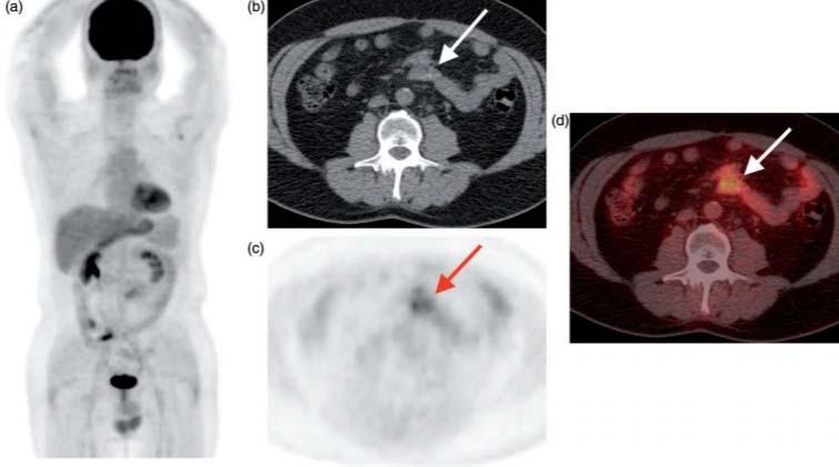 FNHL μεταθεραπευτική PET/CT Αξιολόγηση υπολειπόμενης