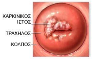 460 πχ Πρώτη αναφορά στον ορισμό «γεννητικά κονδυλώματα» 1842 καρκίνος του τραχήλου «αφροδίσια φύση» 1907 Ιϊκή φύση δερματικών κονδυλωμάτων (Ciufo) 1965 Δομικά και μοριακά χαρακτηριστικά του HPV DNA