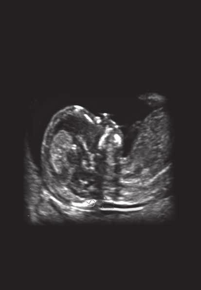 3rd TRIMESTER ULTRASONOGRAPHY Πέµπτη &