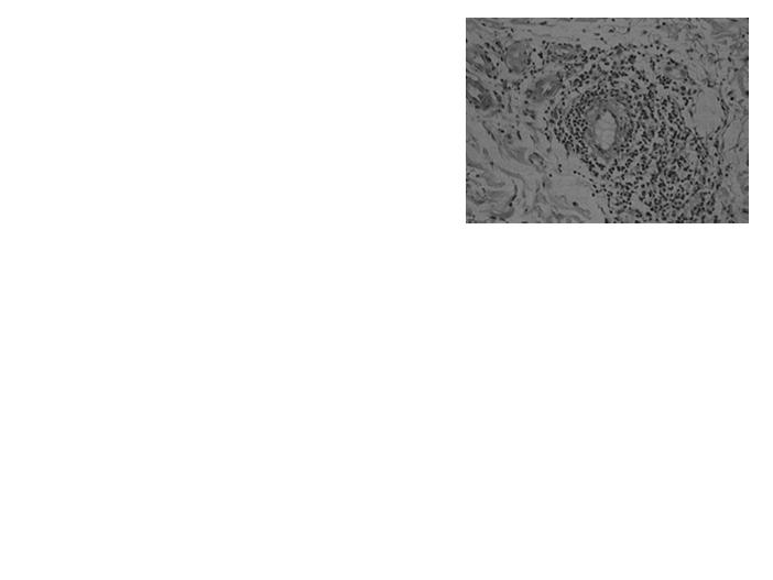 infiltrate of macrophages, and CD4+ and CD8+ lymphocytes and NK cells Skin Exanthema