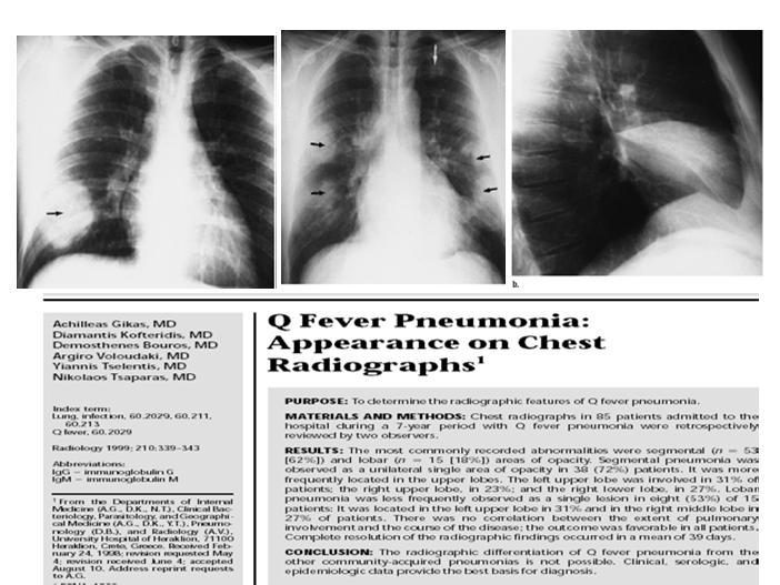 Χρόνιος πυρετός Q Λοίμωξη > 6 μήνες + Υψηλοί τίτλοι IgG φάσης I Μπορεί να συνοδεύουν τον οξύ πυρετό Q για μήνες ή χρόνια μετά την λοίμωξη Λοιμώδης ενδοκαρδίτιδα: στο 60 70% όλων των χρόνιων
