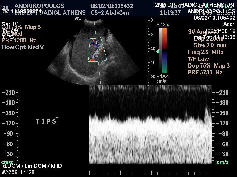 Παρακολούθηση ασθενούς με TIPS Έγχρωμο Doppler Υπερηχογράφημα (DUS) 24h 1 εβδομάδα 1 μήνα 3 μήνες 6 μήνες Κάθε 3 ή 6 μήνες Φυσιολογικό: -