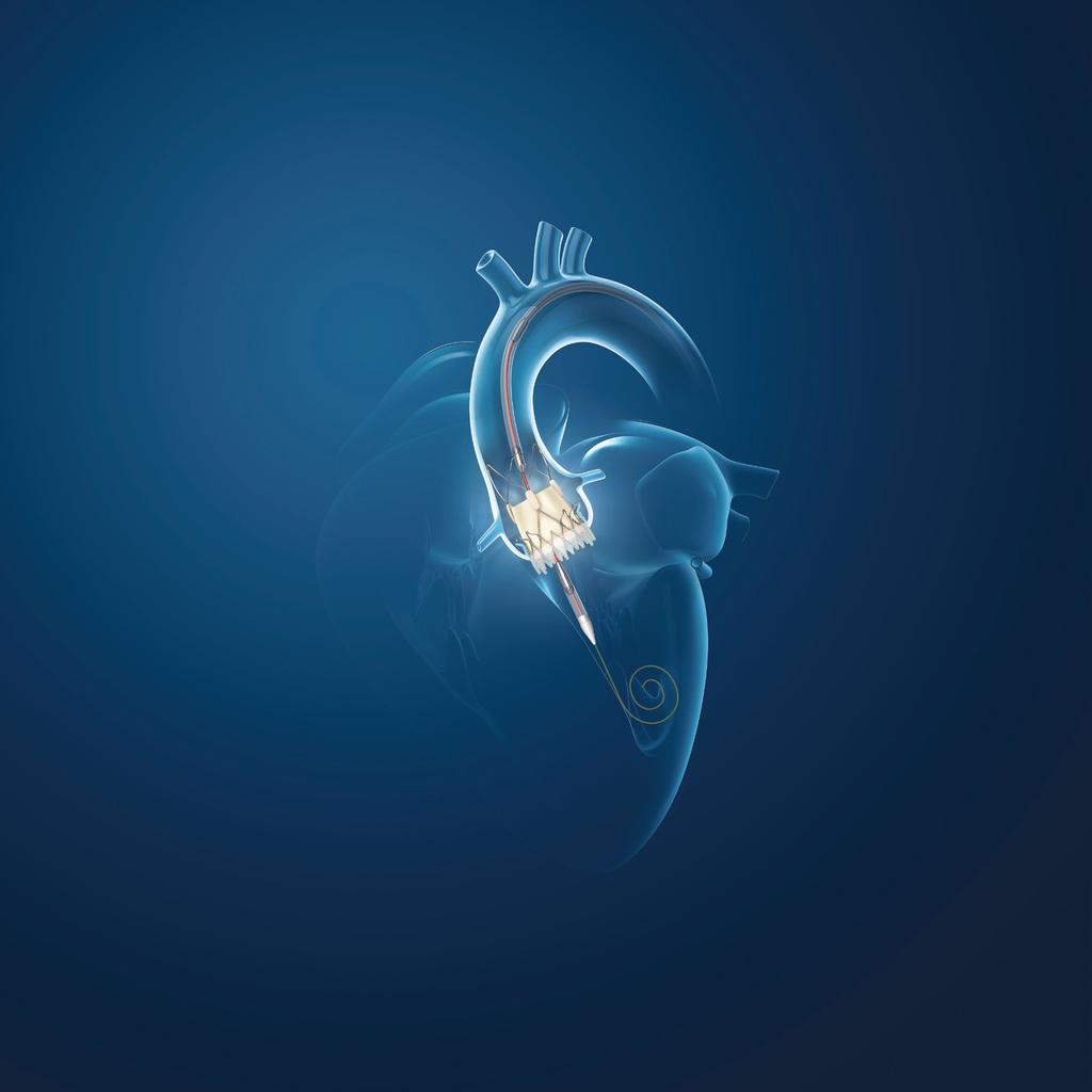 OPTIMIZING TAVI ACURATE neo s unique self-expanding, supra-annular valve design delivers outstanding clinical outcomes including very high survival rates with excellent hemodynamics and low pacemaker