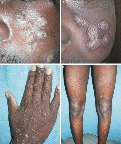 dermatitidis Coccidioides immitis Histoplasma