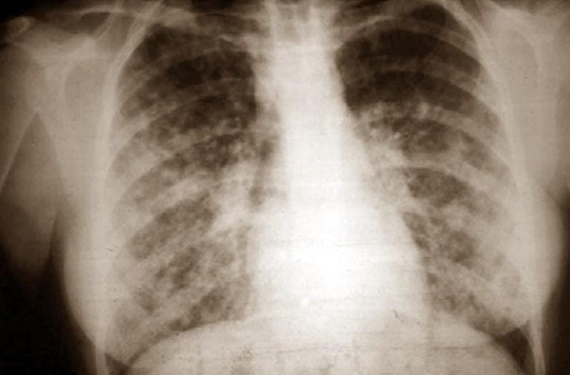 Xρόνια πνευμονική νόσος Μεγάλες κοιλότητες στον πνεύμονα Αρχικές μολύνσεις ή επαναδραστηριοποίηση αλλοιώσεων που είχαν αποθεραπευθεί προσφάτως