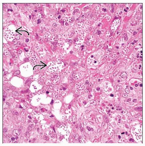 Διάγνωση Επιχρίσματα και χρώση απαραίτητα Χρώση PAS σε τομές ιστών : μορφή μικρών ωοειδών κυττάρων ζυμών (2-3 x 3-4