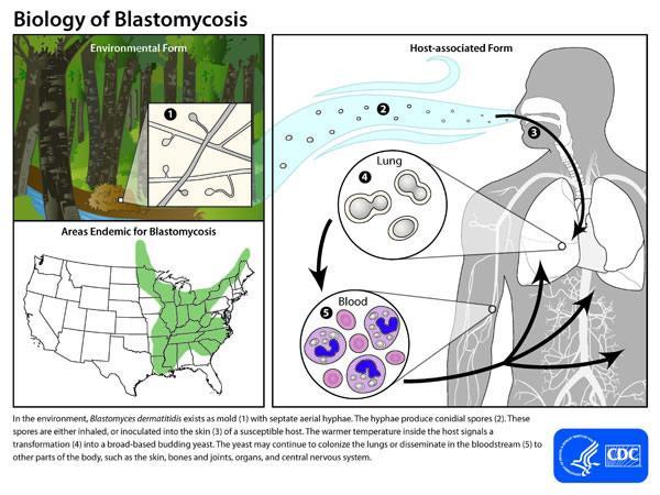 Blastomyces dermatitidis Ενδημικός μύκητας Προκαλεί λοιμώξεις σε περιοχές της Β.