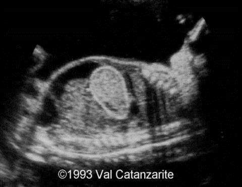 ΨΕΥΔΟΚΥΣΤΗ Longitudinal view of the fetal abdomen.