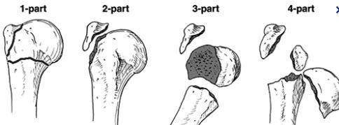 Κατάγματα του άνω άκρου του βραχιονίου-ταξινόμηση κατά Neer Το άνω άκρο χωρίζεται σε 4 τμήματα: την κεφαλή, τη διάφυση, το έλασσον βραχιόνιο