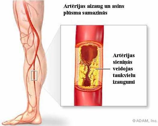Turbulences rašanās iespējas asiħu plūsmā Normā asins turbulenta plūsma ir tikai aortā.