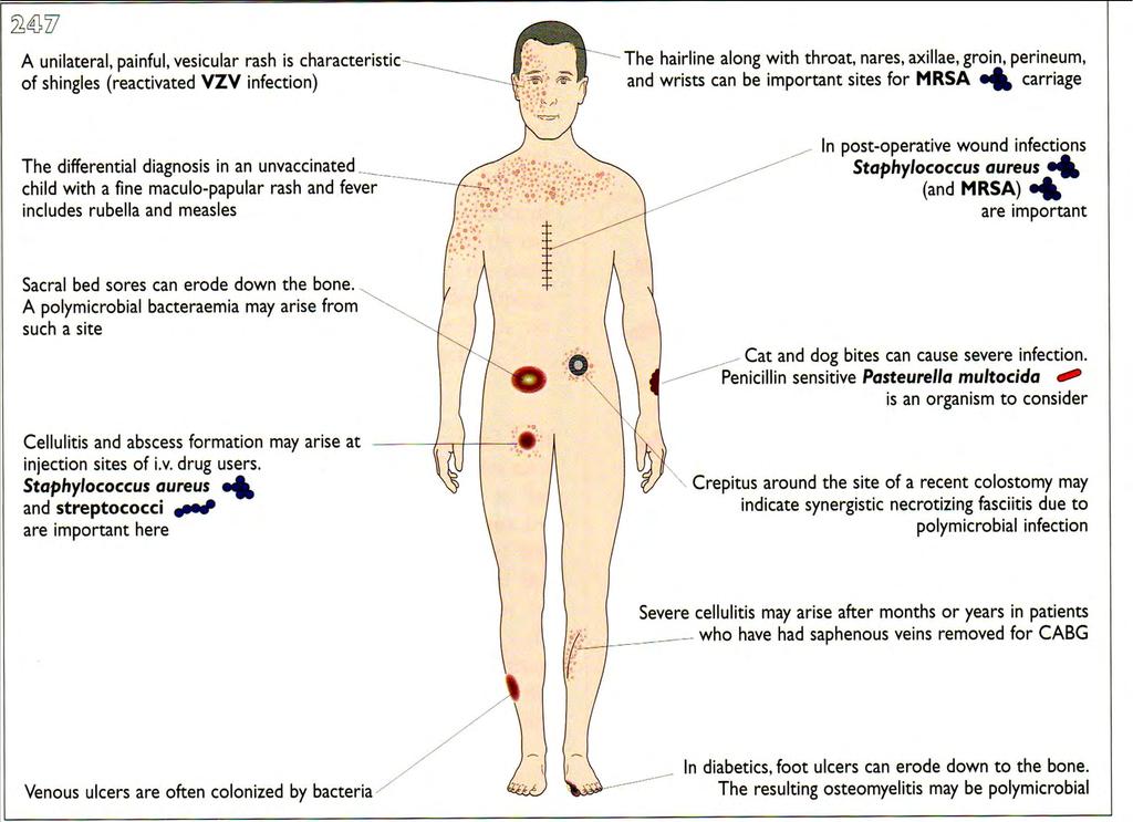 Ακμή Bartonella henselae