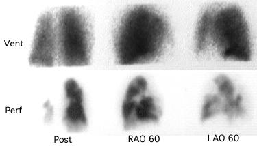 6. V/Q scan Διάγνωση χρόνιας θρομβοεμβολικής νόσου-πνευμονικής υπέρτασης(cteph) Low-normal V/Q scan αποκλείει