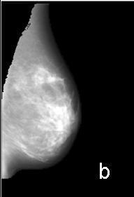 Seifalian and Michael Brady: "A mammographic image analysis method to detect