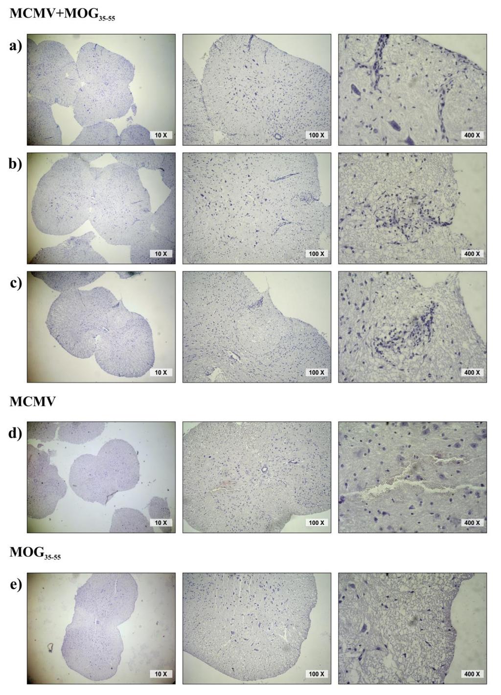 Слика 4 Слика 4: Хистологија кичмене мождине 15 дана од имунизације пептидом MOG35-55 BALB/c мишева инфицираних вирусом 10 дана пре имунизациије (BALB/c MCMV+MOG35-55), BALB/c мишева само инфицираних