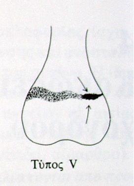 Τύπος V Σπάνιος τύπος Δύσκολη η διάγνωση Κακή η πρόγνωση Σύνθλιψη