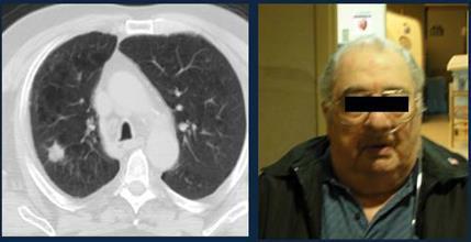 NSCLC: