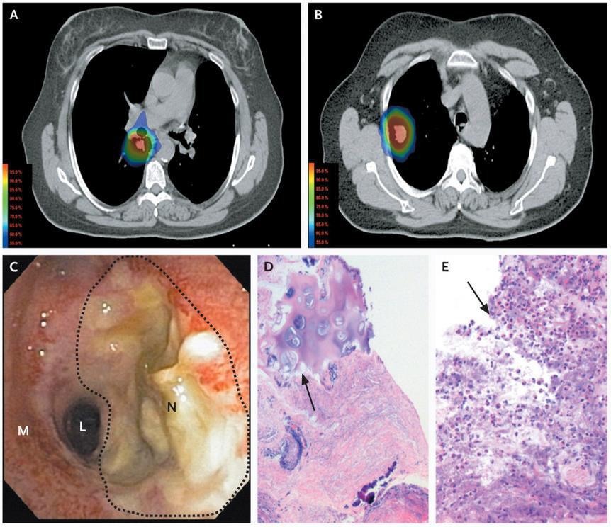 NSCLC: Ω SBRT CORRADETTI, M. N., HAAS, A. R. & RENGAN, R.
