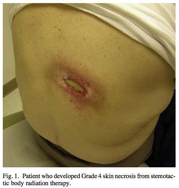 NSCLC: GRADE 4 Ω SBRT HOPPE, B. S. ET AL.